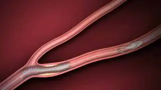 ACCULINK