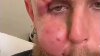 I Think My Jaw Is Broken (Remix) feat. Jake Paul 