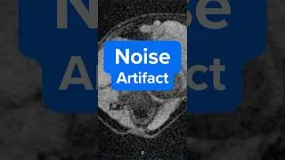 MRI Noise Artifact &ndash; Why It Happens and How to Fix It