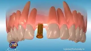 Anterior Implant