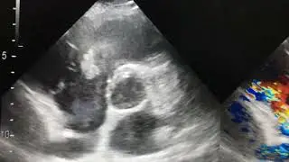 Interesting great vessel echo finding &ndash;please your thoughts 🤔? 
