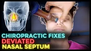 टेढ़ी नाक की समस्या? CHIROPRACTIC TECHNIQUE से मिलेगा SHOCKING आराम!