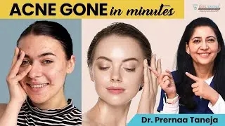 Acne Gone in Minutes!: Carbon Peel Treatment | Carbon Peel for Acne | Clinic Eximus