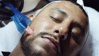 CIT-Microneedling Treatment | Dallas Skin Care Specialists | Jewel Skin Studio