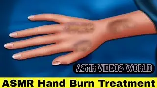 ASMR Hand burn Treatment Skincare Burn treatment Of hand Best video animation