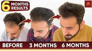 Hair Transplant Before and After Results After 6 Month | Grade 3 Baldness | 1568 Grafts