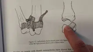 CMC joint arthritis  - what this joint looks like.