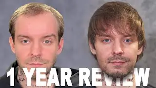 1 YEAR HAIR TRANSPLANT REVIEW
