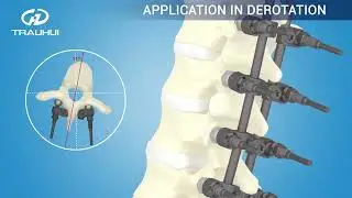 Trauhui Spine posterior fixation system- CCS side loading