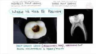 INDIRECT PULP CAPPING & DIRECT PULP CAPPING||REVISED