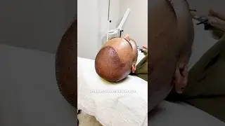 FUE Hair Transplant Turkey - 10th Month Update @cabhealth #hairtransplant #hairtransplantturkey