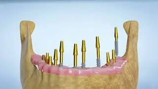 Sample dental implant 3D explainer video