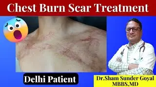 Burn Scar Treatment Cost | Laser Scar Removal | Burn Scars
