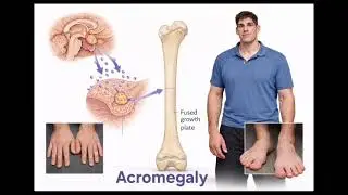 Rare endocrine disorders #Gigantism and Acromegaly.