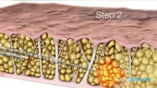 Cellusmooth Cellulite Treatment in Fairfax & Manassas - Washington DC