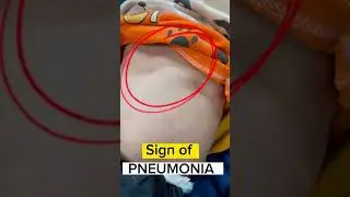 Danger Signs in #pneumonia  #pneumonia #signs