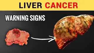13 early silent signs of Liver Cancer (Don't ignore) symptoms of Liver Cancer । Liver Cancer