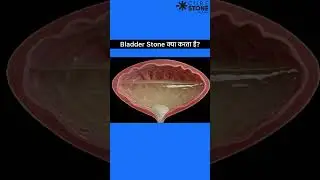 How does bladder stone blocks the urethra | How bladder stone causes obstruction