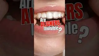 Are Aligners Really Invisible? #youtubeshorts #invisiblealigners #invisalign #aligners #braces