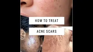 MEDICAL AESTHETICIAN ADVICE: How to treat Acne Scarring