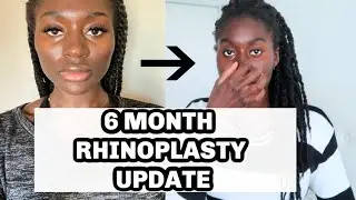6 Month Rhinoplasty Update | Dr. Bora | My Current Thoughts | Jessica's Area