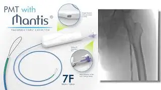 Mantis&reg;️ Thrombectomy System for DVT