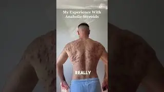 Steroids side effect, back acne