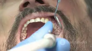 Кариес 🦷 Симптомы, которые НИКОГДА нельзя игнорировать #вирусный