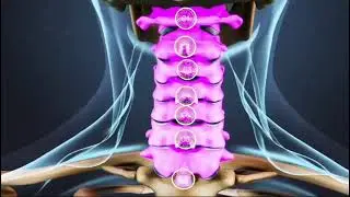 cervical facet arthritis