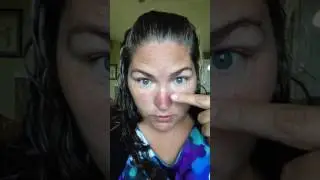 Senederm Trial day 7