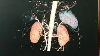 Full work of TPCT Liver (How to create 3D imeage from arterial phase) on GE 16 Slice Scanner