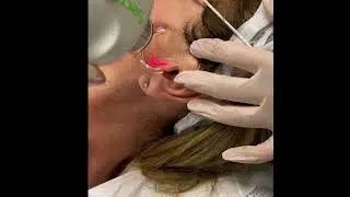 Co2 skin resurfacing. #co2laser #skinrejuvenation #skincareroutine #skinrenewal #laserresurfacing