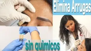 Eliminando Arrugas con Plasma SIN QUIMICOS