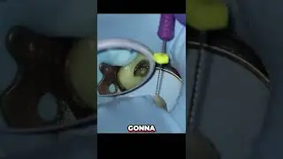 Cone Fit Radiograph Prep  Dentist's Trick for Perfect Length!