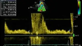 REVERSE DIASTOLIC FLOW / DESCENDING AORTA