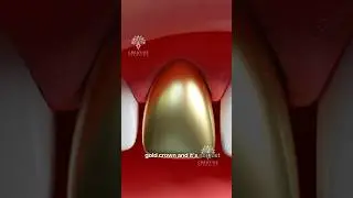 Why Do Some People Prefer Gold Tooth Over Porcelain? 🤔 #short #goldtooth- Creativelearning3d