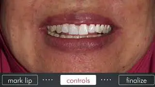 DSDApp Denture Upper  Malaysia