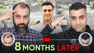 Hair Transplant in Nagpur (HX-ATYR) | Best Results & Cost of Hair Transplant in Nagpur.
