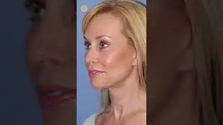 Lower Facelift and Deep Plane Neck Lift | Dr. Kevin Sadati #plasticsurgery #facelift #liposuction