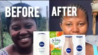 HOW I RESTORED MY SKIN |Safe skin lightening| Evidence Based Skin Reatoration | Removed Dark spots.