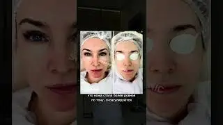 Фотоомоложение на аппарате ALMA HARMONY XL PRO в Solar Beauty Clinic