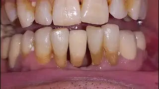 Maryland Bridge. Fixed teeth. Minimal tooth damage