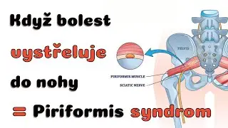 Když bolest vystřeluje ze zad přes zadek do nohy - Piriformis syndrom | Luk&aacute;&scaron; Van&iacute;ček