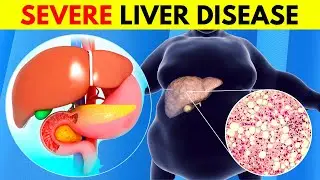 5 UNUSUAL Signs of LIVER DAMAGE - LIVER is DYING!