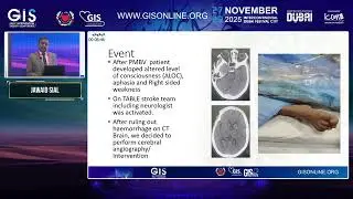 22 Case 3  A Stroke of Luck  Thrombectomy Saves the Day Post PTMC Jawaid Sial