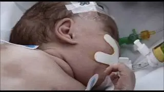 Breastfeeding premature babies