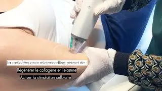 &Eacute;liminer les vergetures - Radiofr&eacute;quence Microneedling POTENZA&reg; - Clinique CLEM &agrave; Lille