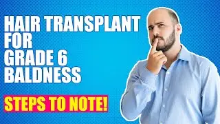 5 THINGS YOU MUST KNOW - FOR GRADE 6 BALDNESS (Hindi) | HAIR TRANSPLANT | DERMALIFE