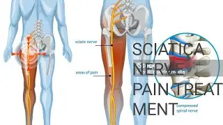 SCIATICA NERVE PAIN AND TREATMENT 