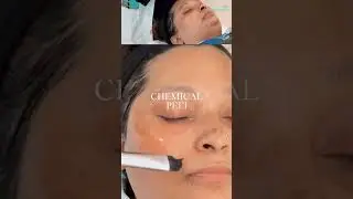 Chemical Peel for Glowing Skin | Brighten, Renew & Reveal with LaserTreat